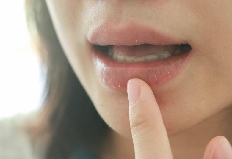 Deshidratación TheraBreath